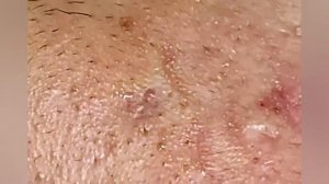 Выдавливание прыщей, угрей, черных точек и камедонов #396