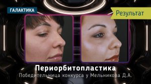 Периорбитопластика спустя 4 месяца | Ольга у Дмитрия Мельникова — естественный результат