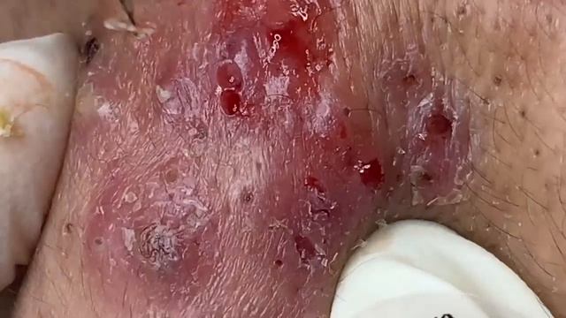 Выдавливание прыщей, угрей, черных точек и камедонов #394