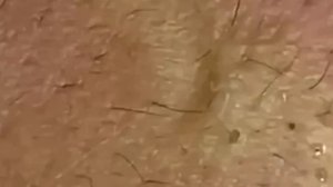 #296 Чистка лица от угрей и акне. Выдавливание прыщей. Удаление черных точек и комедонов