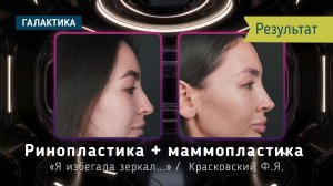 Ринопластика + маммопластика | результат спустя год у Фёдора Красковского