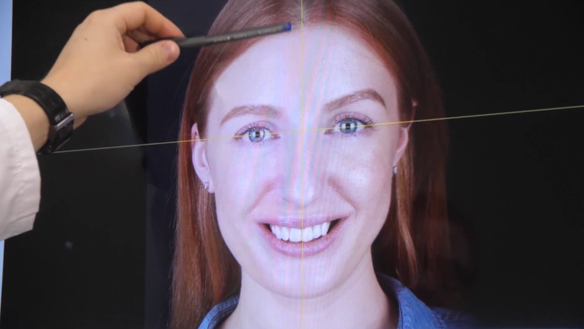 Цифровой дизайн улыбки Digital Smile Design. Опыт пациента Стомпрактики (Челябинск)