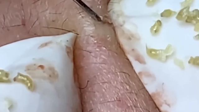 #300 Чистка лица от угрей и акне. Выдавливание прыщей. Удаление черных точек и комедонов