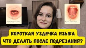 Короткая уздечка языка. Когда начать занятия с логопедом после подрезания уздечки языка?
