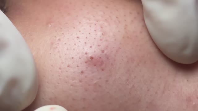 Эффективное удаление акне — ручная чистка лица