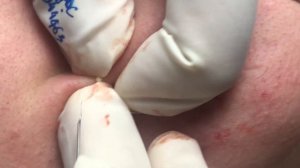 Глубокое удаление черных точек и закрытых комедонов