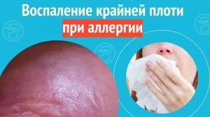 😦 Воспаление крайней плоти при аллергии. Клинический случай №1309