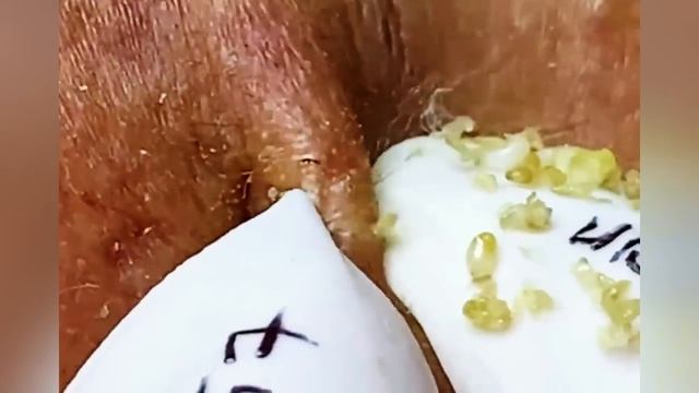 Выдавливание прыщей, угрей, черных точек и камедонов #397