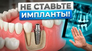 Кому НЕЛЬЗЯ ставить импланты? Стоматологи МОЛЧАТ об этом