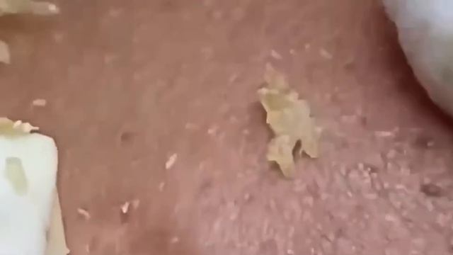 #301 Чистка лица от угрей и акне. Выдавливание прыщей. Удаление черных точек и комедонов