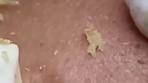 #301 Чистка лица от угрей и акне. Выдавливание прыщей. Удаление черных точек и комедонов