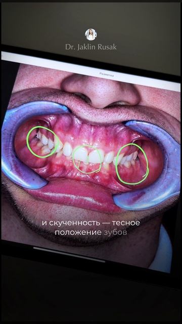 Глубокий прикус — одна из самых частых проблем 🦷