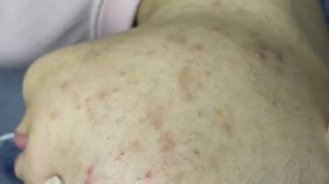 105 • Acne collection • АСМР • Relax Spa