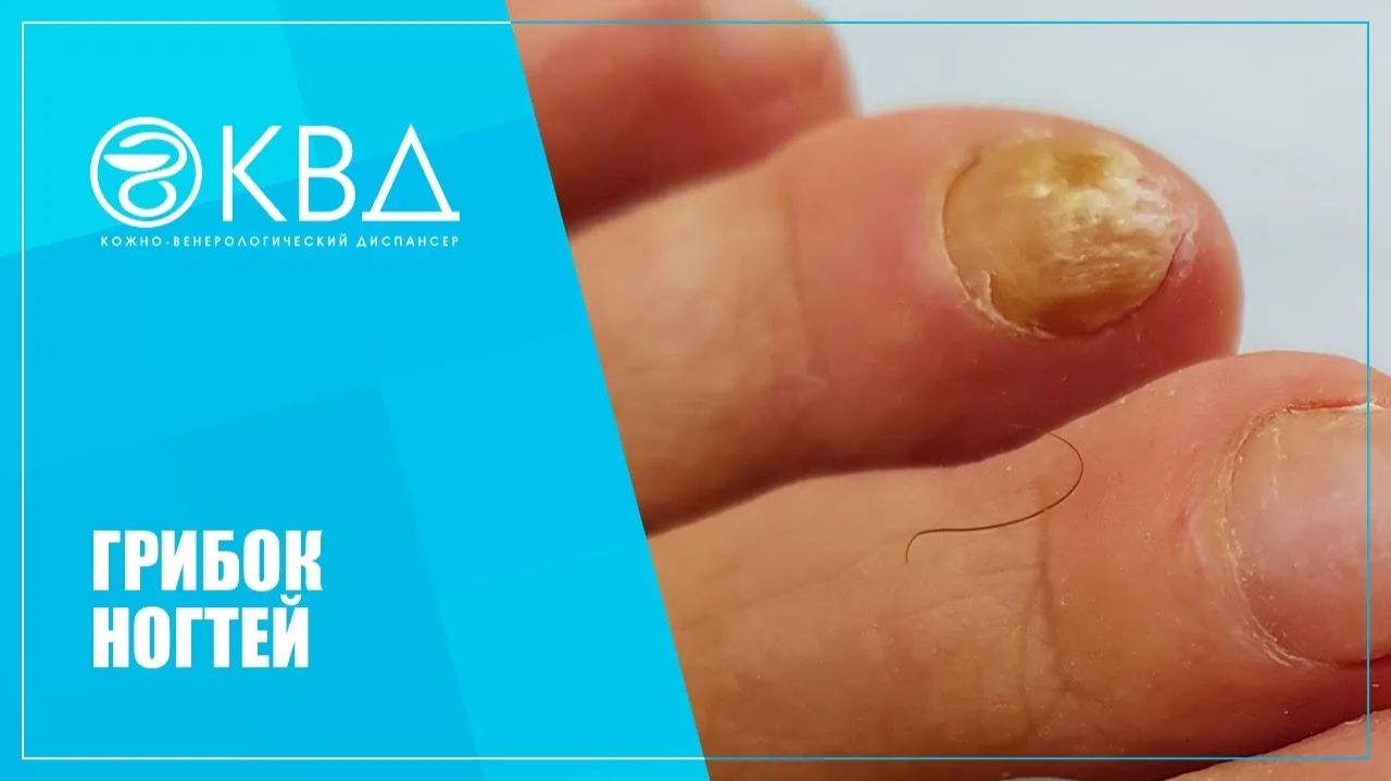 Грибок ногтей. Клинический случай №134