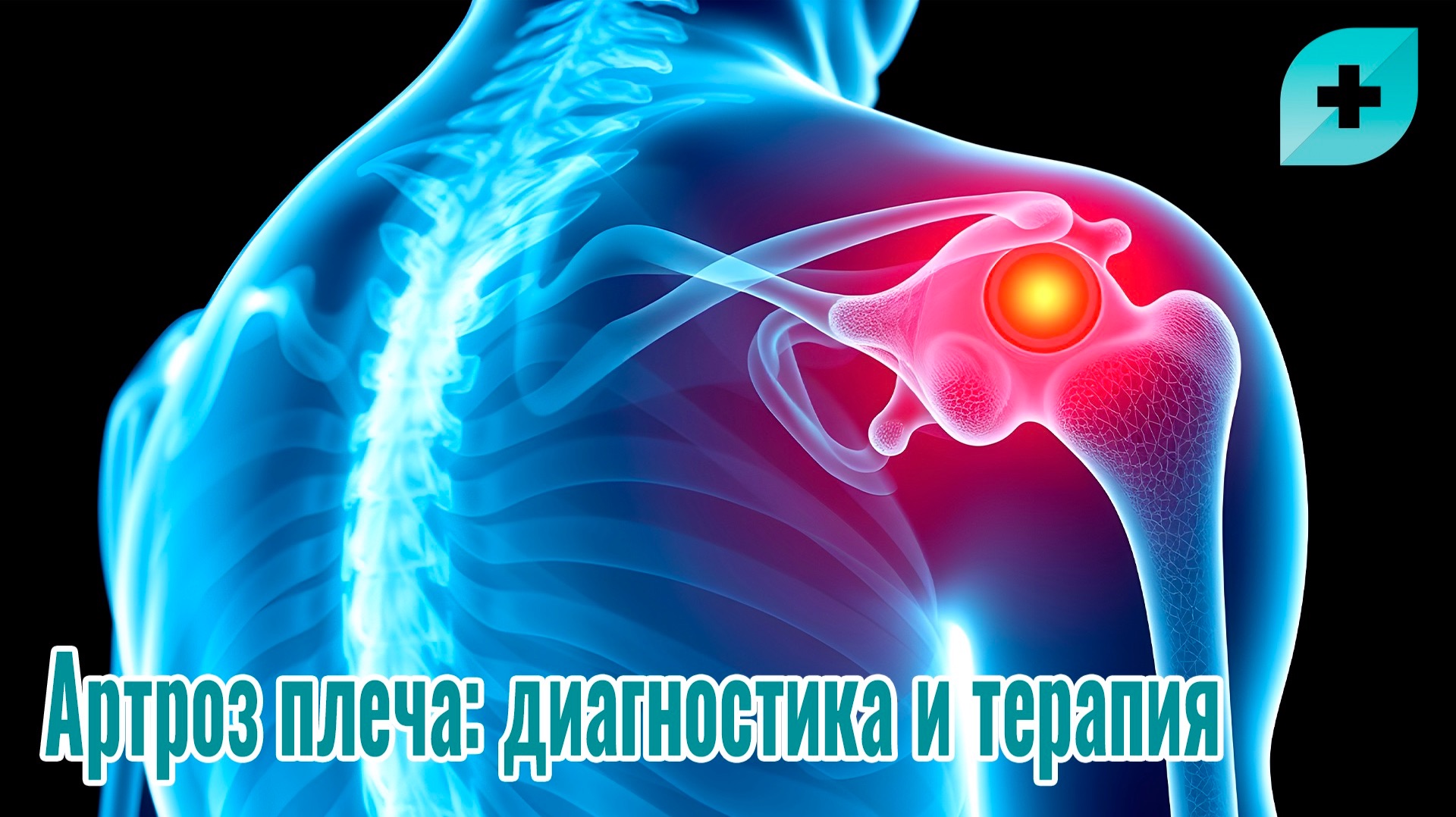 Артроз плеча: диагностика и терапия