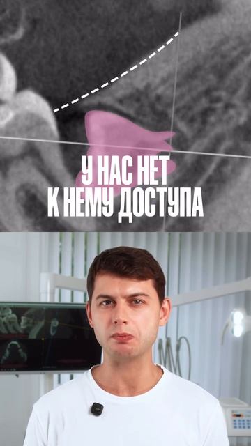 Удаление ретенированного дистопированного зуба мудрости