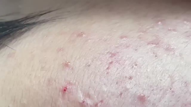 Полное очищение лица от акне