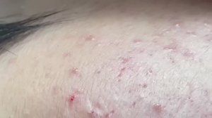 Полное очищение лица от акне