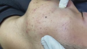 108 • Acne collection • АСМР • Relax Spa