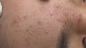 Удаление подкожных прыщей