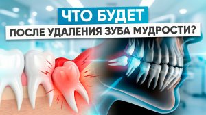 Удалили ЗУБ МУДРОСТИ: что МОЖНО И НЕЛЬЗЯ делать после операции