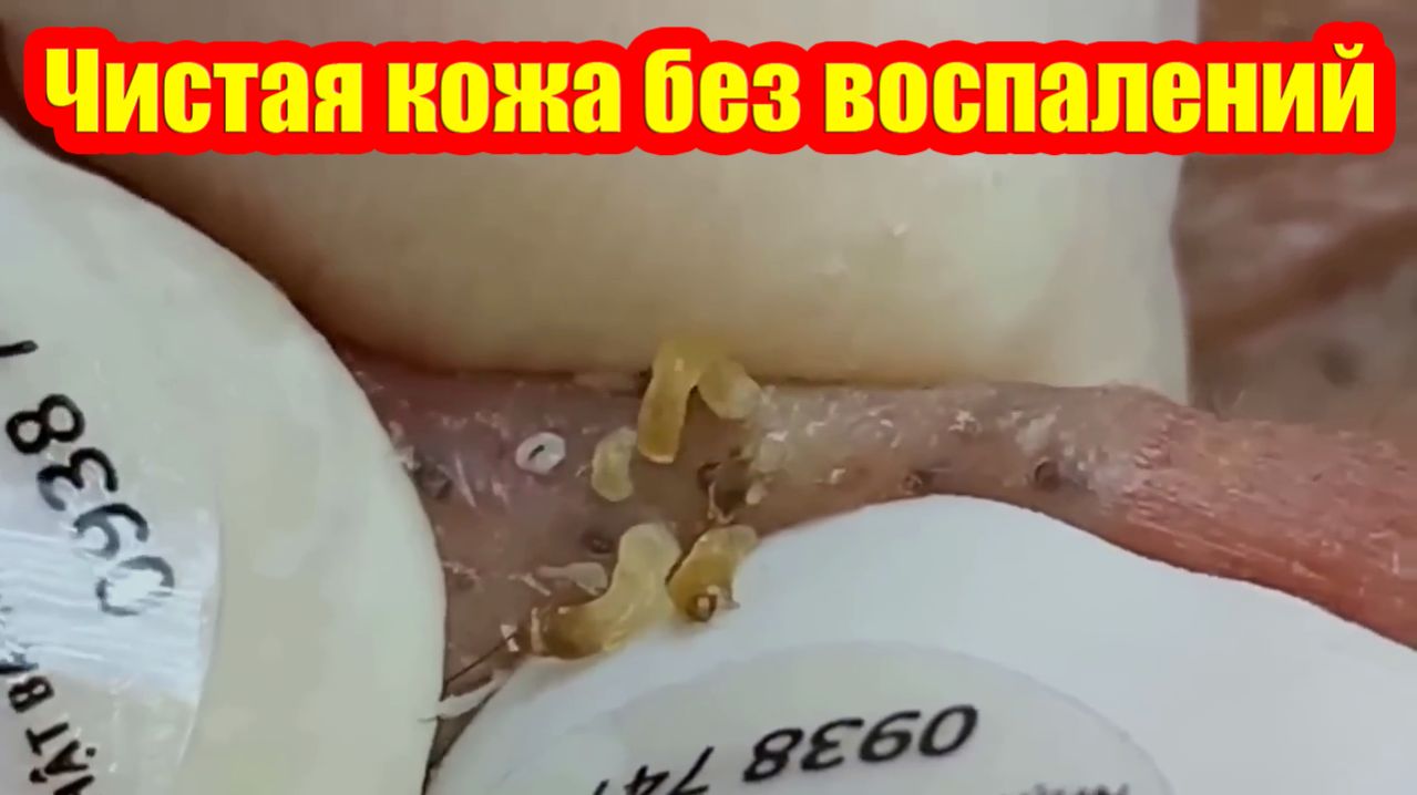 Чистая кожа без воспалений | Глубокая чистка от угревой сыпи