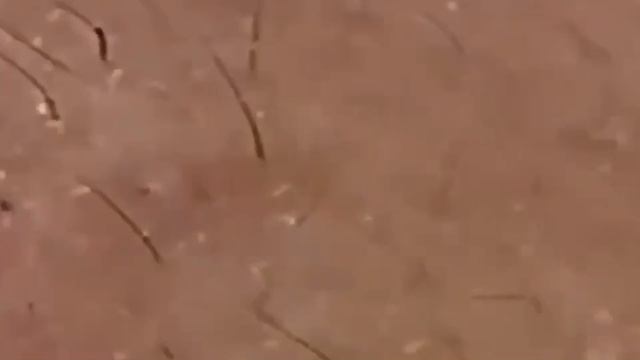 303 Чистка лица от угрей и акне. Выдавливание прыщей. Удаление черных точек и комедонов