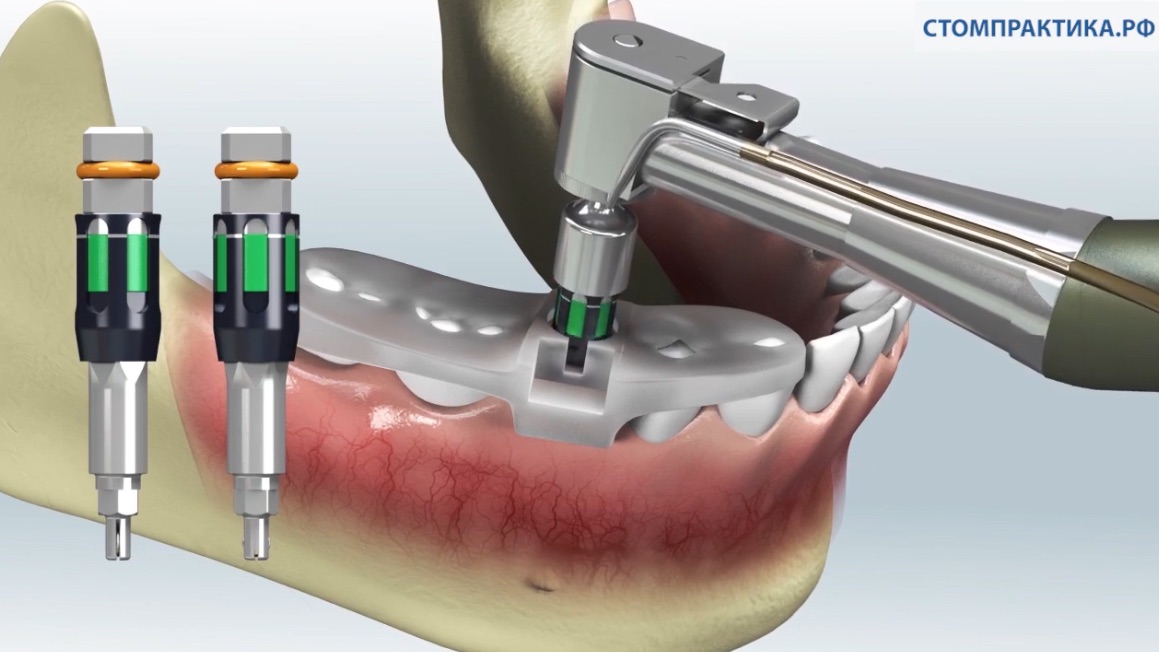 Шаблонная имплантация R2Gate в Стомпрактике