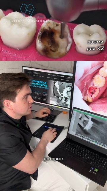 Сломанный инструмент в канале - это еще не повод удалять зуб.