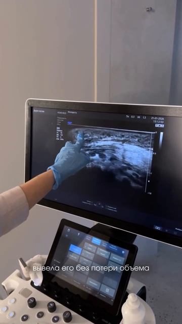 МИГРАЦИЯ ФИЛЛЕРА В ГУБАХ