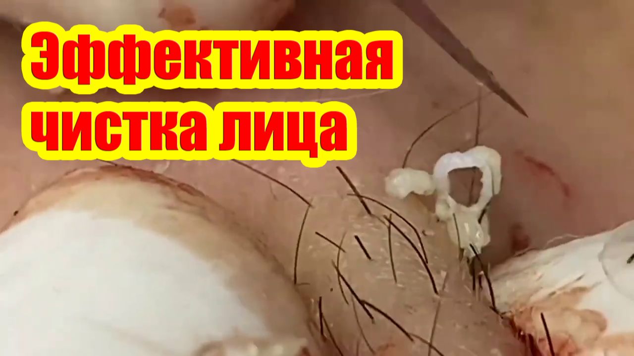Эффективная чистка лица | Глубокая чистка от угревой сыпи