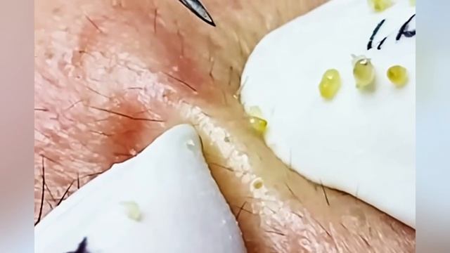 Выдавливание прыщей угрей черных точек и камедонов 400