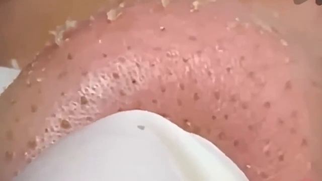 #302 Чистка лица от угрей и акне. Выдавливание прыщей. Удаление черных точек и комедонов