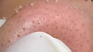 #302 Чистка лица от угрей и акне. Выдавливание прыщей. Удаление черных точек и комедонов