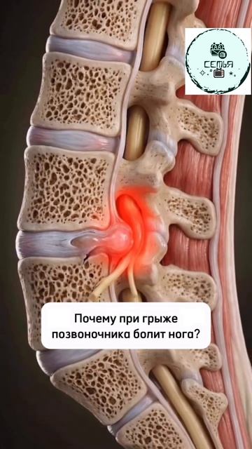 ПОЧЕМУ ПРИ ГРЫЖЕ ПОЗВОНОЧНИКА БОЛИТ НОГА