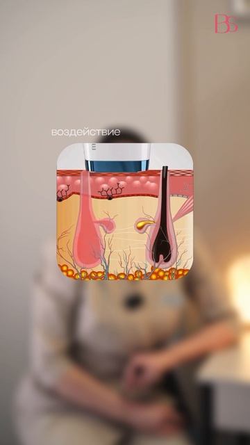 Лазерная эпиляция во время критических дней: за и против?