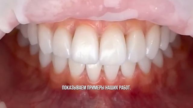 титры виниры 1