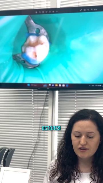 Кариес под пломбой