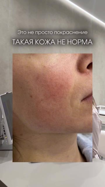 КАК ЛЕЧИТЬ РОЗАЦЕА?