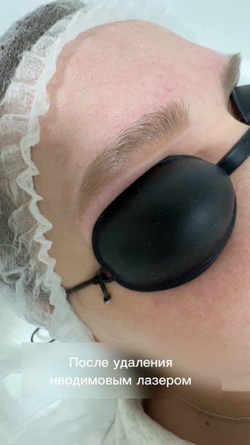 Удаление перманентного макияжа