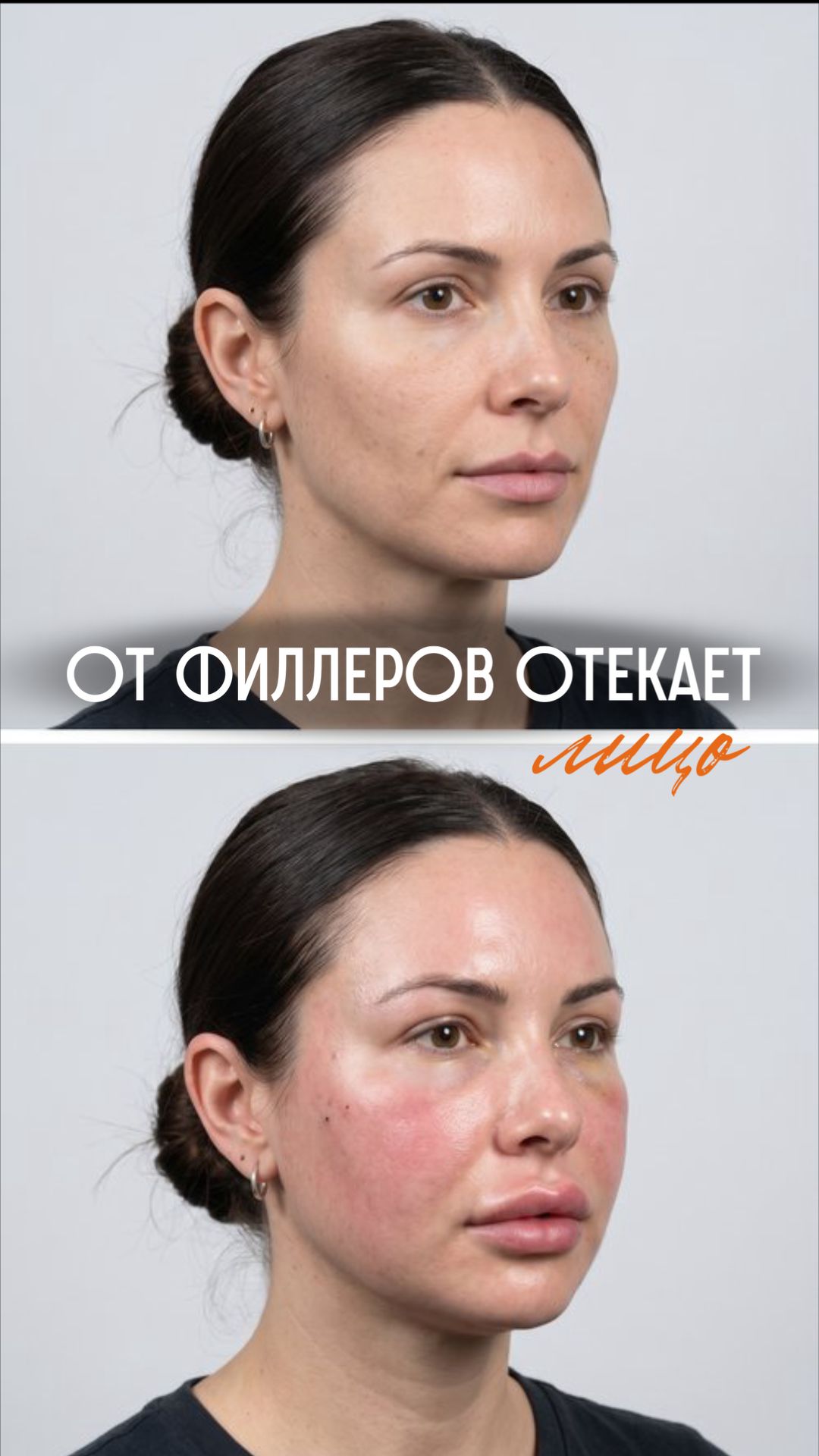 Почему лицо отекает после филлеров филлеры косметолог косметология отек врачкосметолог лицо