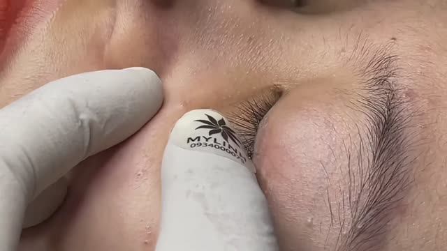 Сальные пробки и их извлечение. Расслабляющий процесс.