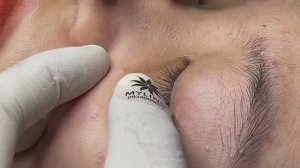 Сальные пробки и их извлечение. Расслабляющий процесс.