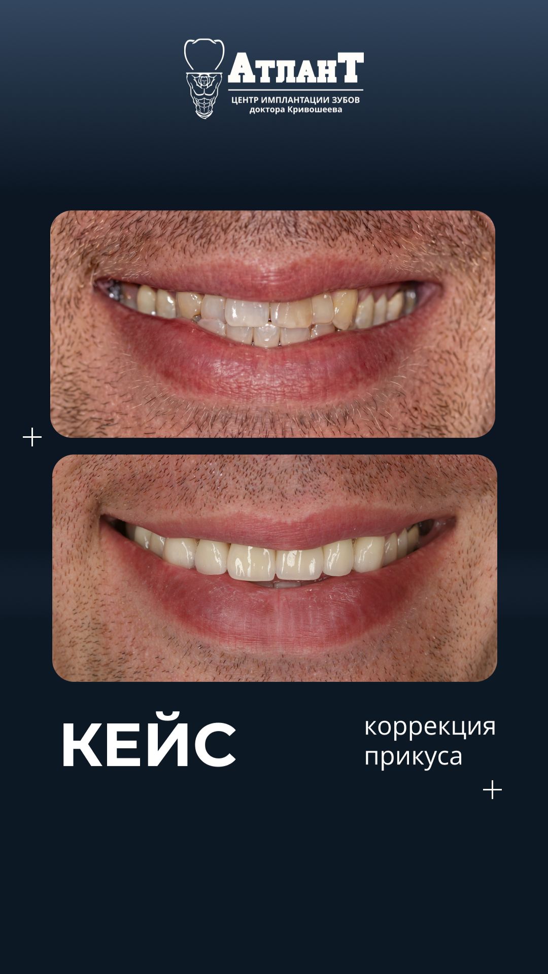 Исправление сложной зубо-челюстной аномалии ортодонтия гнатохирургия и протезирование shorts