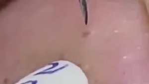 #303 Чистка лица от угрей и акне. Выдавливание прыщей. Удаление черных точек и комедонов