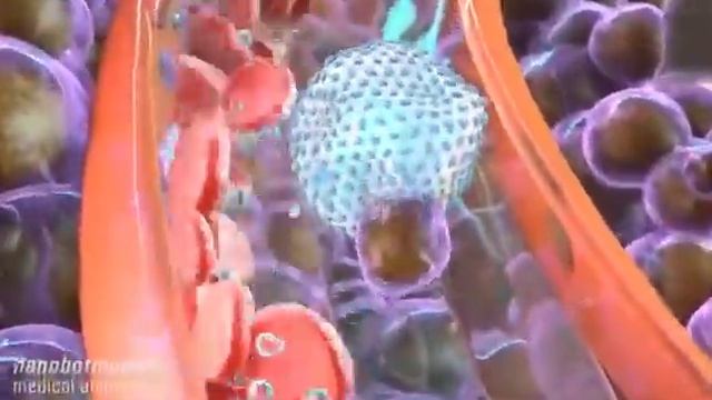 Метастазирование Как происходит появление новых раковых опухолей