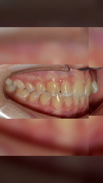 Кейс: ортодонтическое лечение брекетами за 11 месяцев