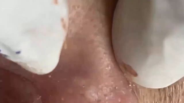 Выдавливание внутренних прыщей. Глубокое очищение 887599