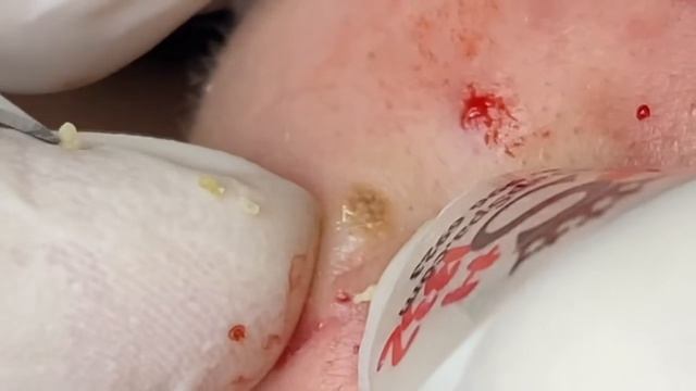 Выдавливание прыщей угрей черных точек и камедонов 402