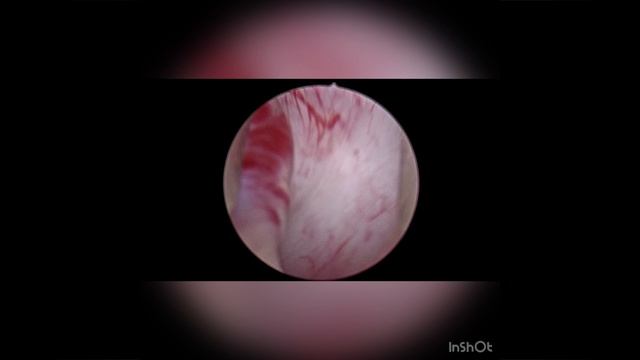 Необычная опухоль мочеточника эндоскопическая картина